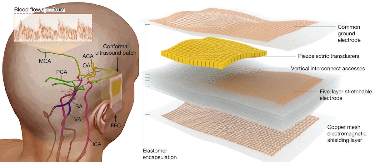 Wearable ultrasound patch