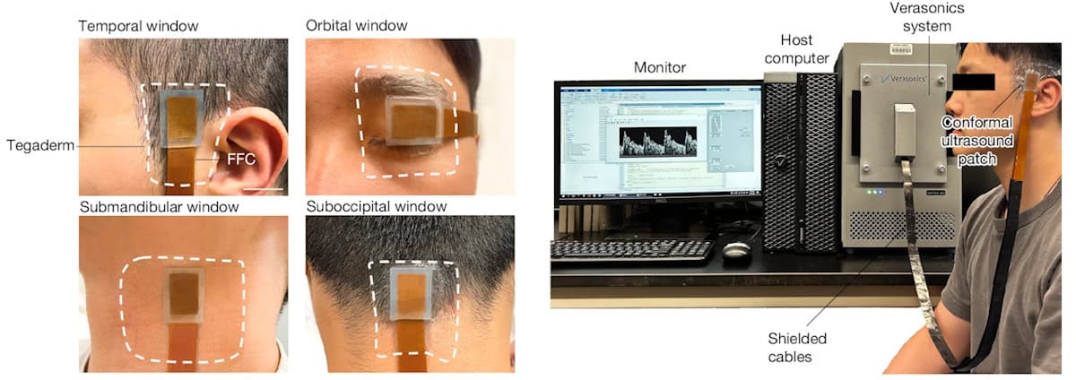 Volunteer testing of a wearable ultrasound patch